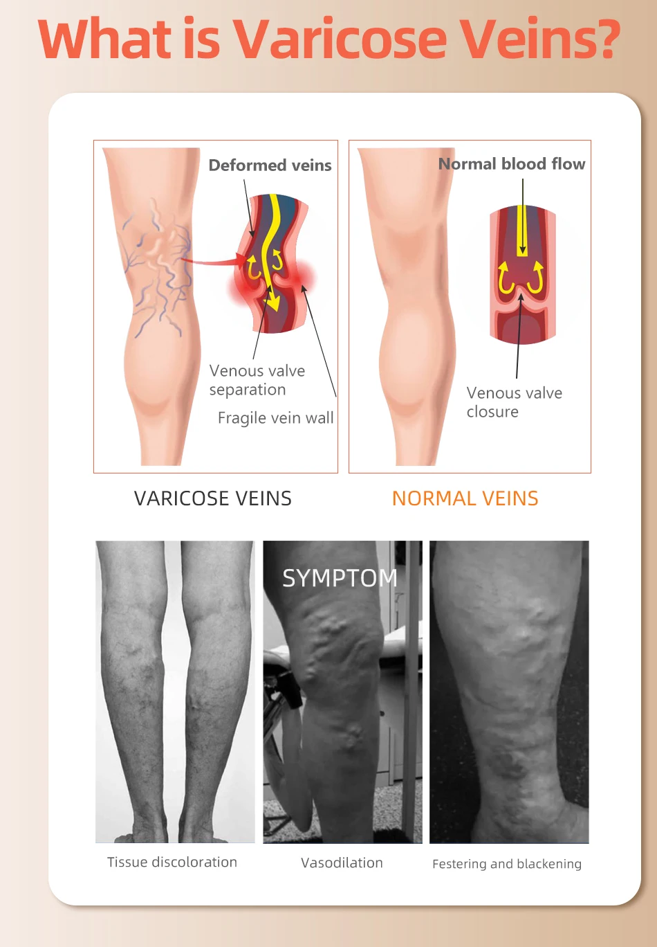 30-40 MmHg Over Knee Closed To - Compression Sock Medical review and price